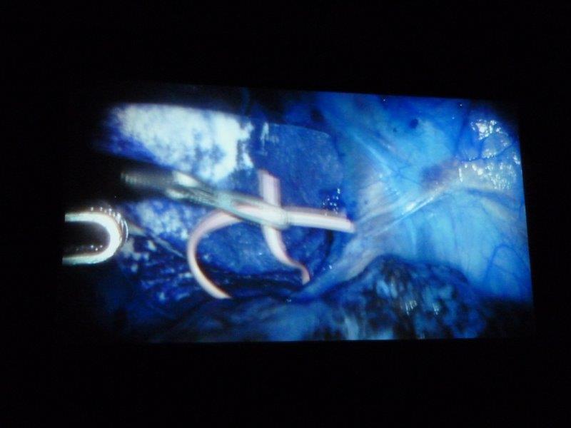 Film still showing endoscopic surgery